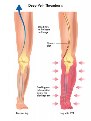 deep vain thrombosis