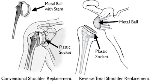 Reverse shoulder replacement