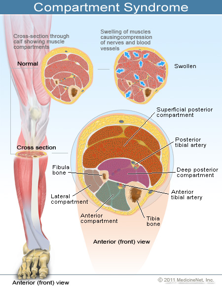 compartment-syndrome