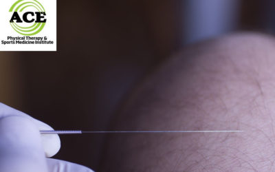 DRY NEEDLING IN PHYSICAL THERAPY