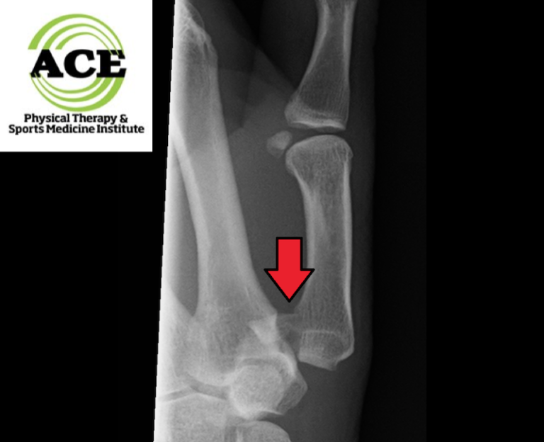Fracture Alexandria Thumb Rehabilitation Arlington