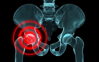 The Difference between Tendonitis and Osteoarthritis of the Hip