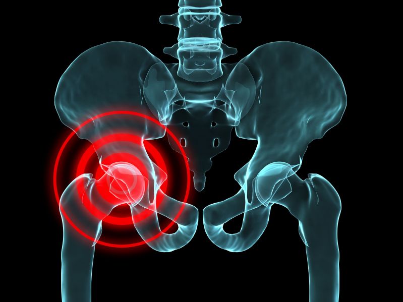 arthritis hip