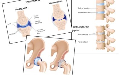 Osteoarthritis