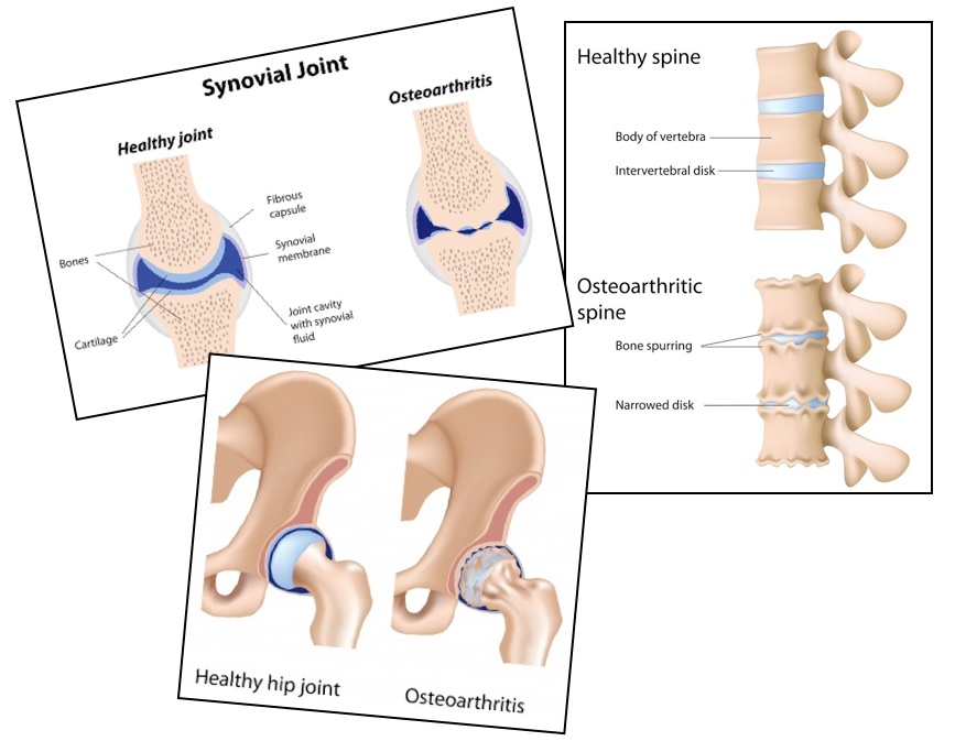 Osteoarthritis