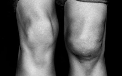 Quad and Patellar Tendon Ruptures