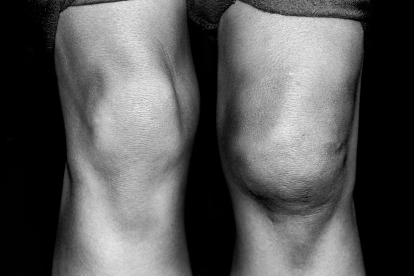 Quad and Patellar Tendon Ruptures