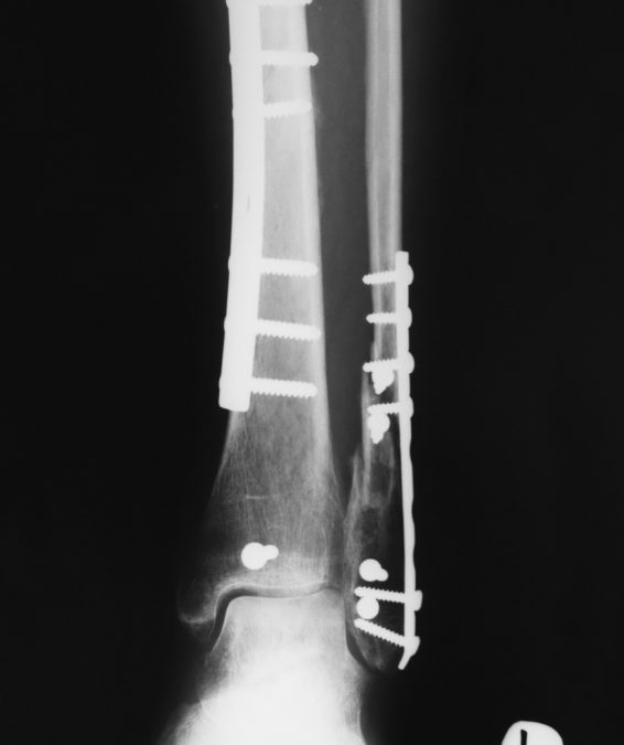 Treating Ankle Fractures