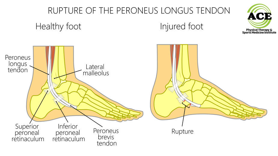 Peroneal Tendon