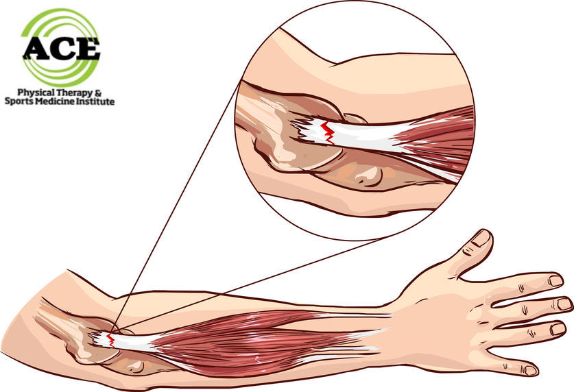 Tendinopathy