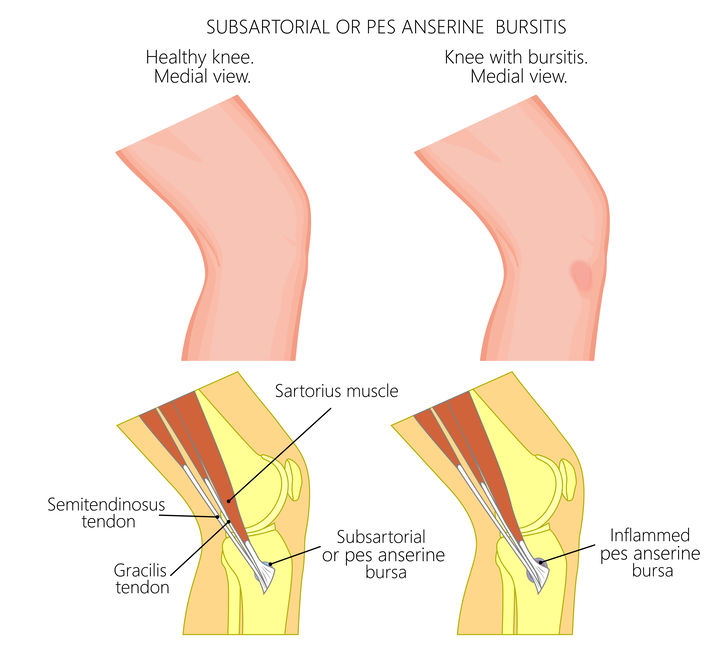 medial knee pain